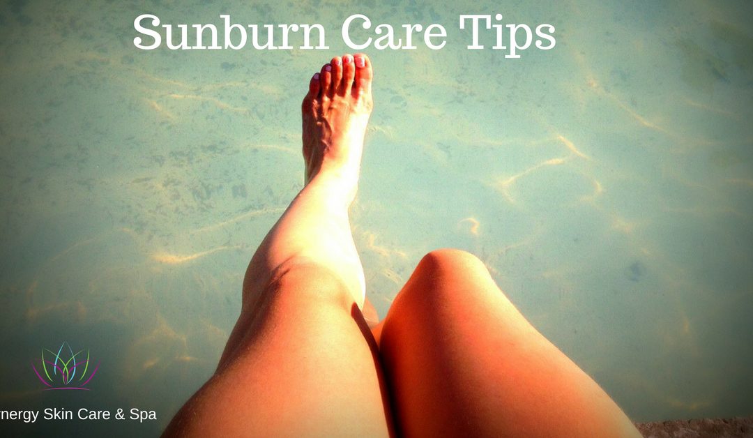 Sunburn Care Tips